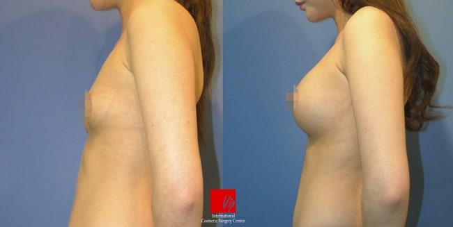 Breast Surgery, Body Contouring - Операция груди - увеличение груди с помощью имплантата круглого типа
