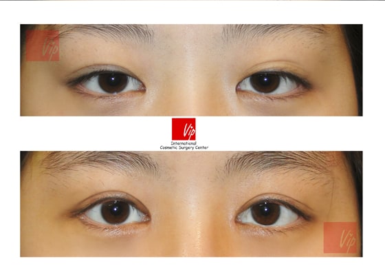 Eye Surgery - Эпикантопластика, операция на двойных веках