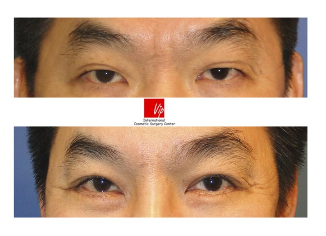 Eye Surgery - Эндоскопическая операция на лбу / Верхняя блефаропластика