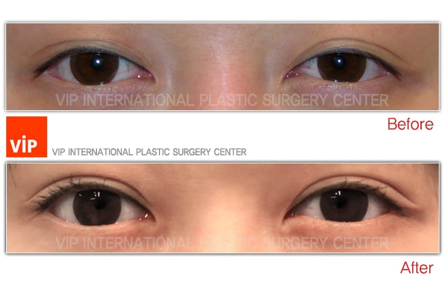 Eye Surgery - Операция "двойное веко" без разреза