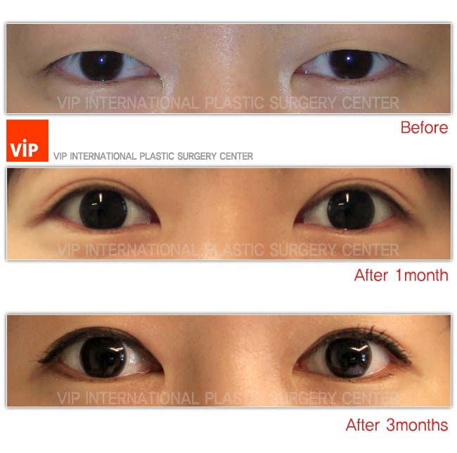 Eye Surgery - Создание "двойного века" и Коррекция птоза до и после