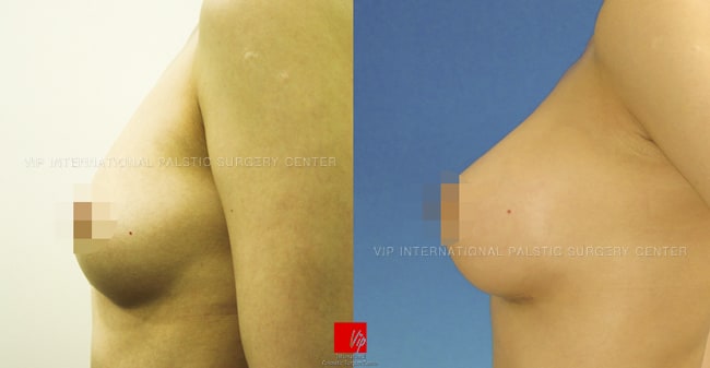 Breast Surgery, Body Contouring - Операция груди, увеличение груди каплевидными имплантатами VIP