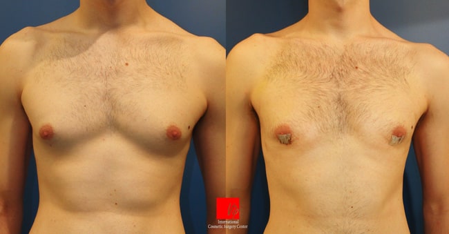 Breast Surgery - Маммопластика | Гинекомастия