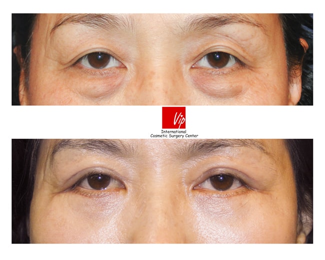 Eye Surgery - Блефаропластика нижнего века