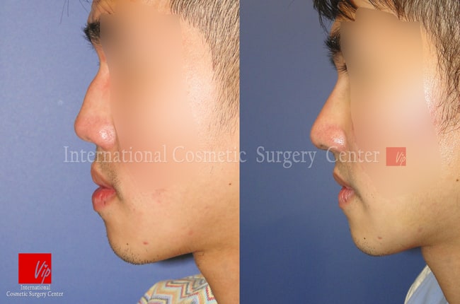 	Harmony-Rhinoplasty, Protruded Mouth Correction Rhinoplasty, Rib cartilage Rhinoplasty	 - Low and deviated male nose