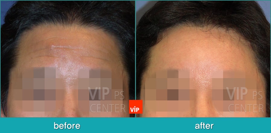 Face Lift, Stem Cell Fat Graft - Подтяжка лица, липофилинг со стволовыми клетками, эндоскопическая подтяжка лба