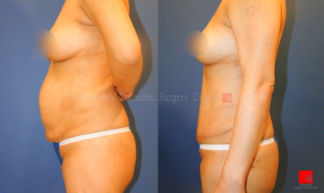 Breast Surgery, Body Contouring - Операция груди, контуринг тела | абдоминальная пластика + липосакция