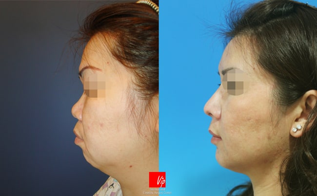 Nose Surgery, Facial Bone Surgery - Искривление перегородки с использованием реберного хряща, Контурная хирургия лица, гениопластика