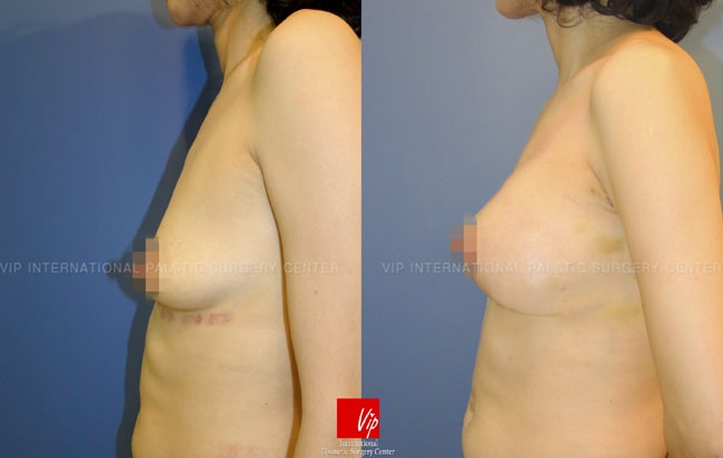 Breast Surgery, Body Contouring - Операция груди, увеличение груди каплевидными имплантатами