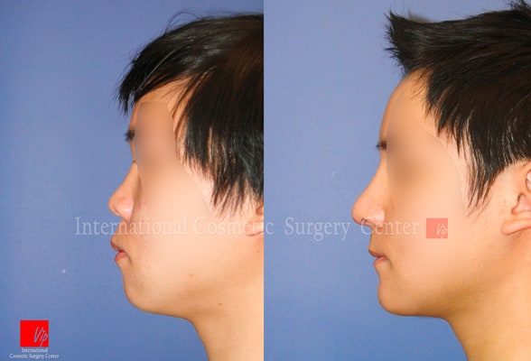 Nose Surgery, Facial Bone Surgery - Ринопластика с коррекцией выпяченного рта, ринопластика с использованием реберного хряща, гениопластика