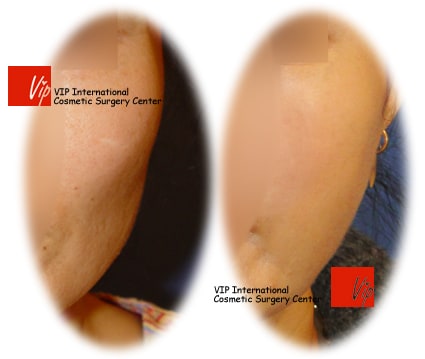 Stem Cell Fat Graft - Липофилинг щек и висков