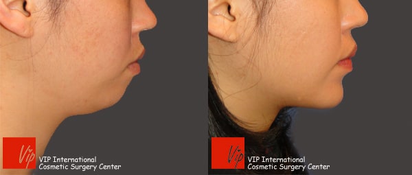 Facial Bone Surgery - Челюстно-лицевая хирургия, гениопластика - смещение кости подбородка вперед