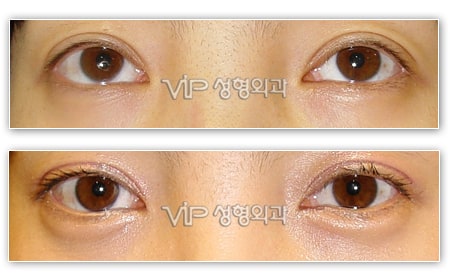 Eye Surgery - Инъекции филлера возле глаз
