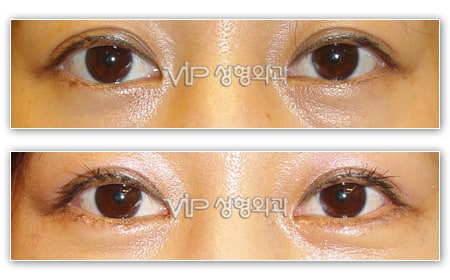 Eye Surgery - Процедура при морщинах вокруг глаз