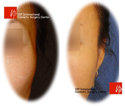 Stem Cell Fat Graft - Липофилинг щек и висков