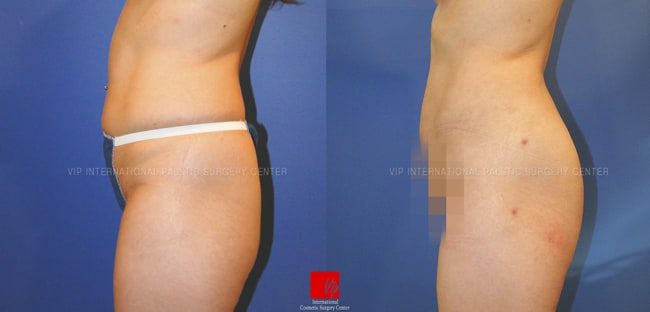 Stem Cell Fat Graft, Body Contouring - Липофилинг стволовыми клетками, Контуринг тела | увеличение попы липофилингом