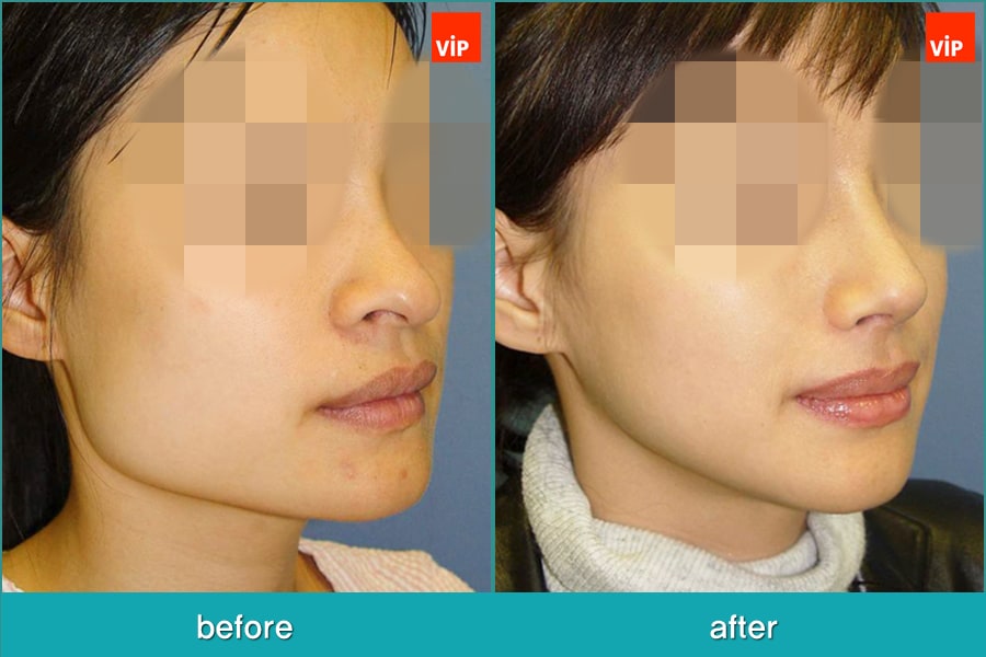 Nose Surgery, Facial Bone Surgery - Искривление перегородки, лицево-челюстная хирургия, ринопластика