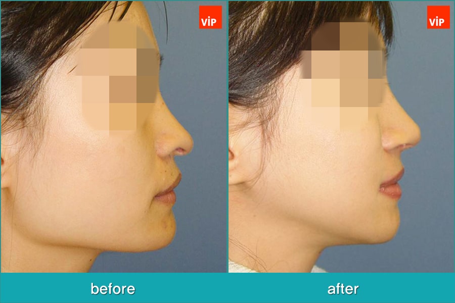 Nose Surgery, Facial Bone Surgery - Искривление перегородки, лицево-челюстная хирургия, ринопластика