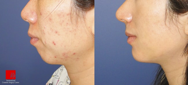 Facial Bone Surgery - Челюстно-лицевая хирургия, гениопластика
