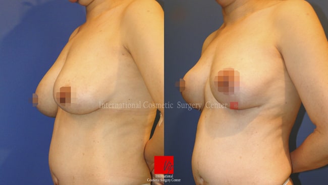 Breast Surgery - Подтяжка груди
