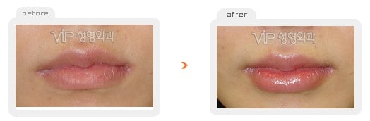Stem Cell Fat Graft - Липофилинг стволовыми клетками на губах
