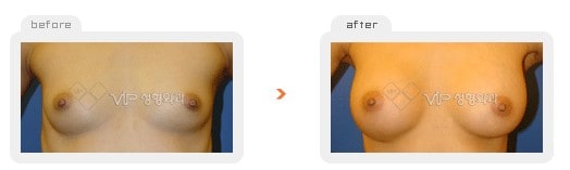 Breast Surgery - Операция по увеличению груди