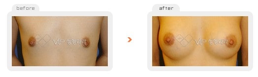 Breast Surgery - Операция по увеличению груди