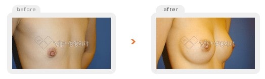 Breast Surgery - Операция по увеличению груди