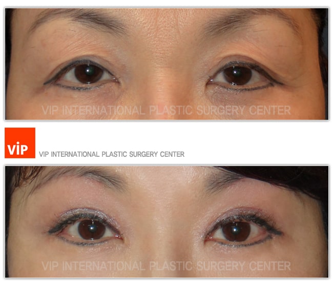 Eye Surgery - Подтяжка бровей до и после