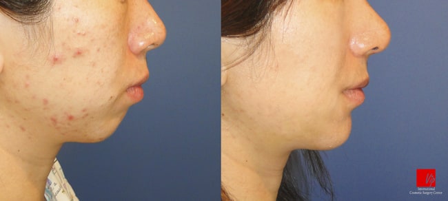 Facial Bone Surgery - Челюстно-лицевая хирургия, гениопластика