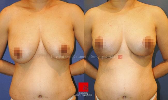 Breast Surgery - Подтяжка груди