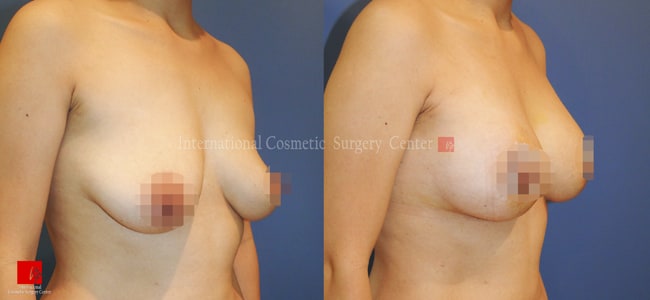 Breast Surgery, Body Contouring - Подтяжка и увеличение груди