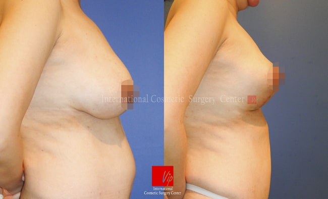 Breast Surgery - Подтяжка груди