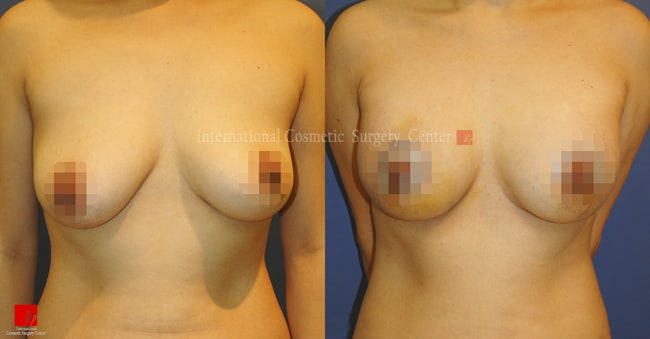 Breast Surgery, Body Contouring - Подтяжка и увеличение груди