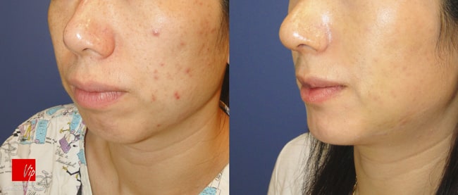 Facial Bone Surgery - Челюстно-лицевая хирургия, гениопластика