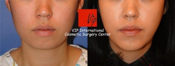 Facial Bone Surgery - Челюстно-лицевая хирургия, гениопластика
