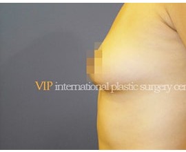 Breast surgery