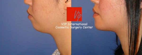 Facial Bone Surgery - Челюстно-лицевая хирургия, гениопластика