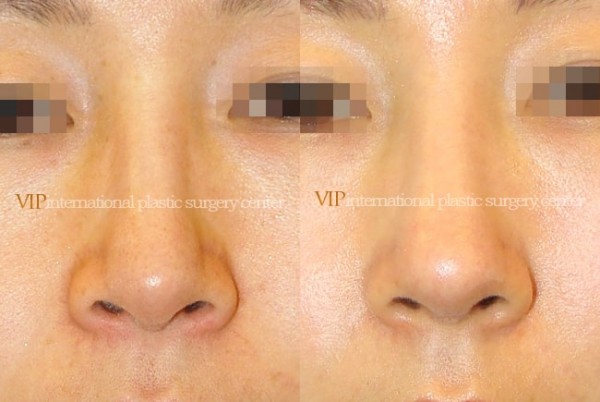 	Nose Surgery	 - Long nose correction