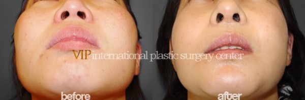 Facial Bone Surgery - Челюстно-лицевая хирургия, уменьшение скул