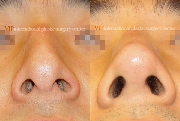 Nose Surgery - Nose bridge correction