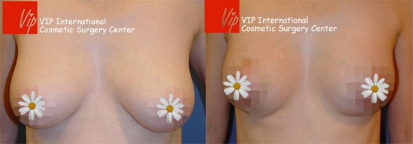 Breast Surgery - Уменьшение груди До и после
