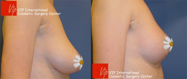 Breast Surgery - Уменьшение груди До и после