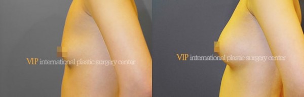 Breast Surgery, Body Contouring - Маммопластика