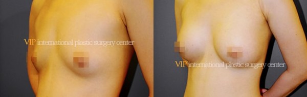 Breast Surgery, Body Contouring - Маммопластика