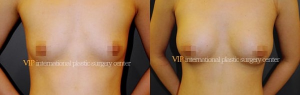 Breast Surgery, Body Contouring - Маммопластика