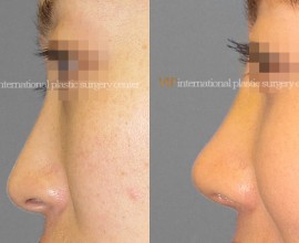 Septal cartilage rhinoplasty