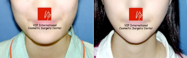 Facial Bone Surgery - Челюстно-лицевая хирургия, уменьшение квадратной челюсти