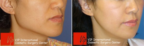 Facial Bone Surgery - Челюстно-лицевая хирургия, уменьшение квадратной челюсти
