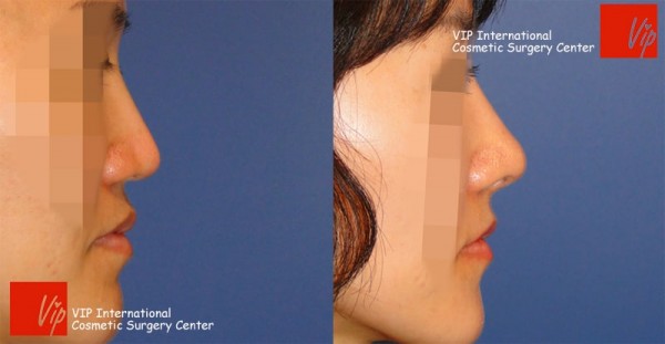 Facial Bone Surgery - Высокотехничная ринопластика VIP